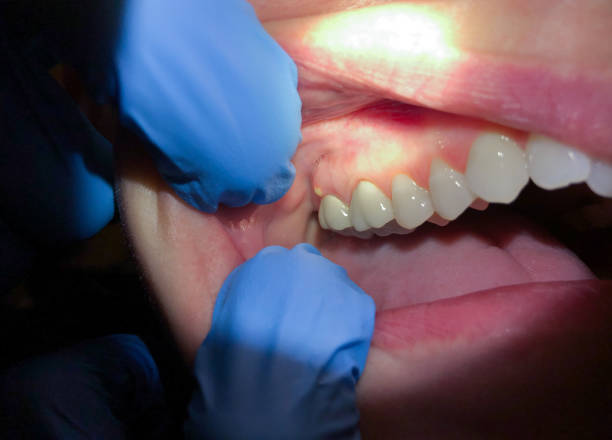 Best Emergency Treatment for Dental Infections or Abscesses in Mountain Home Af, ID